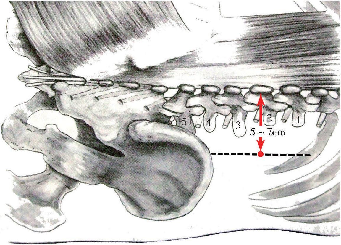 第十一節(jié) 竇椎神經(jīng)注射治療椎弓根內(nèi)固定術(shù)后疼痛
